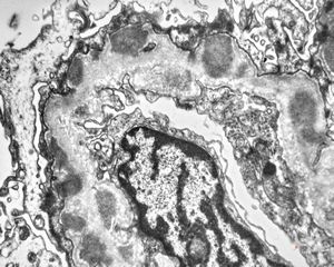 M,7y. | type III membranoproliferative glomerulonephritis M,7y. | type III membranoproliferative glomerulonephritis